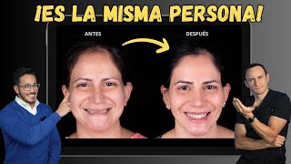 La operación que cambia la forma de tu cara | Cirugía Ortognática de mínima invasión
