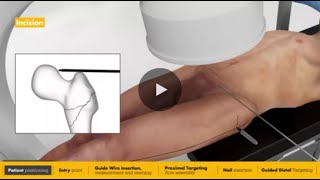 Long Nail surgical animation | Gamma4 Hip Fracture Nailing System