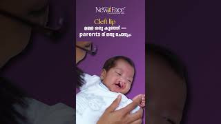 Cleft Lip Baby Surgery | When Is the Right Time? | Dr Mathew PC