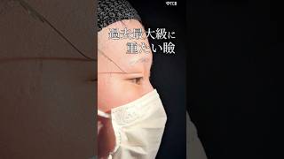 【二重整形】過去最大級に重たい瞼#shorts