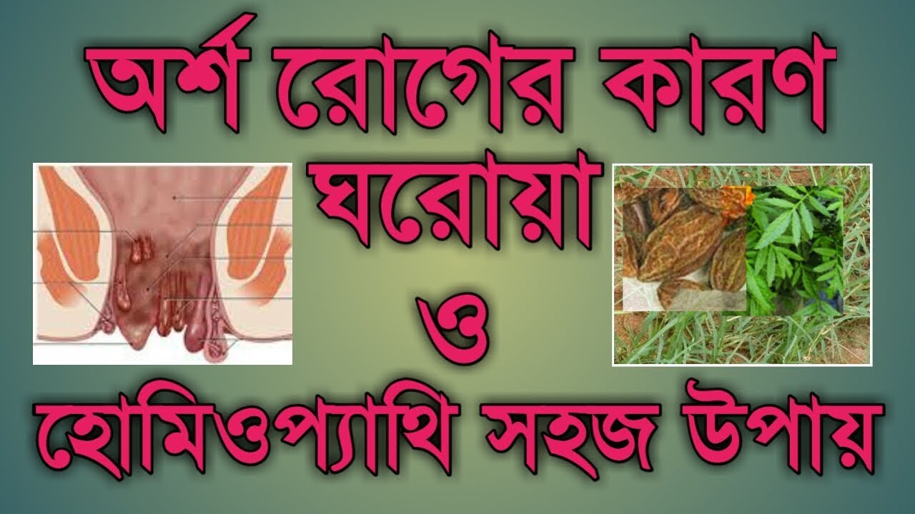 অর্শ রোগের ঘরোয়া চিকিৎসা | হোমিওপ্যাথি চিকিৎসা | piles home & homeopathy treatments in bangla