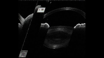 ASOCT in cataract surgery - Supplementary video 1 [ID 286996]