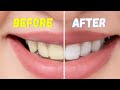 Whiten Your Teeth NATURALLY!