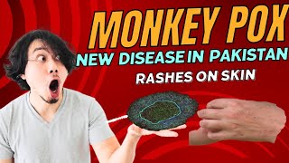 Monkey Pox, New disease in Pakistan...First case reported in Islamabad.....