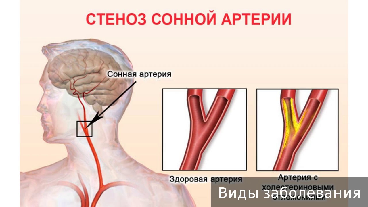 Сонная артерия где на руке. Левая Сонная артерия кровоснабжает. Атеросклероз бляшка сонной артерии. Асимптомный стеноз сонных артерий. Атеросклеротическое поражение сонных артерий.
