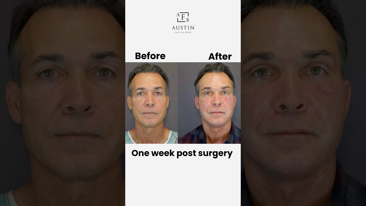 Face and neck lift, brow lift, upper blepharoplasty, facial fat grafting, deep profractional laser&hellip;