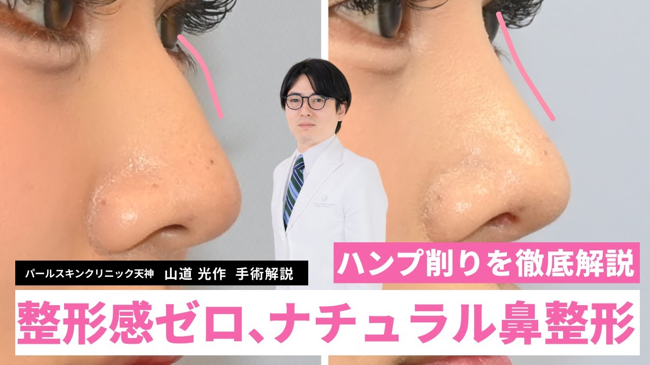 【骨削り】鷲鼻を真っ直ぐに。後悔しないための「ハンプ切除」と鼻先形成の組み合わせ