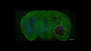 Identifying how a fungus causes damage to the brain