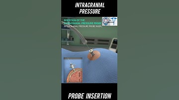 Intracranial pressure (ICP)  probe Insertion #3D Animation/// #Anatomy