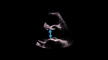 Calculating the aortic valve area
