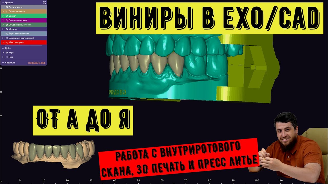 ВИНИРЫ с уровня интроорального скана - 3shape от сканирования до ...