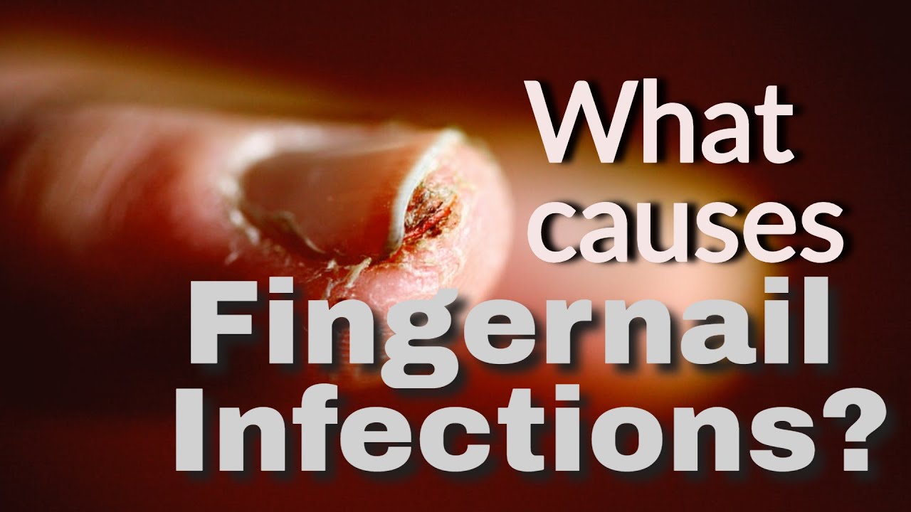 What Causes Fingernail Infections? YouTube