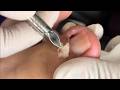Wow, Super Thick Onychomycosis Requires Careful Trimming! #toenails  #11