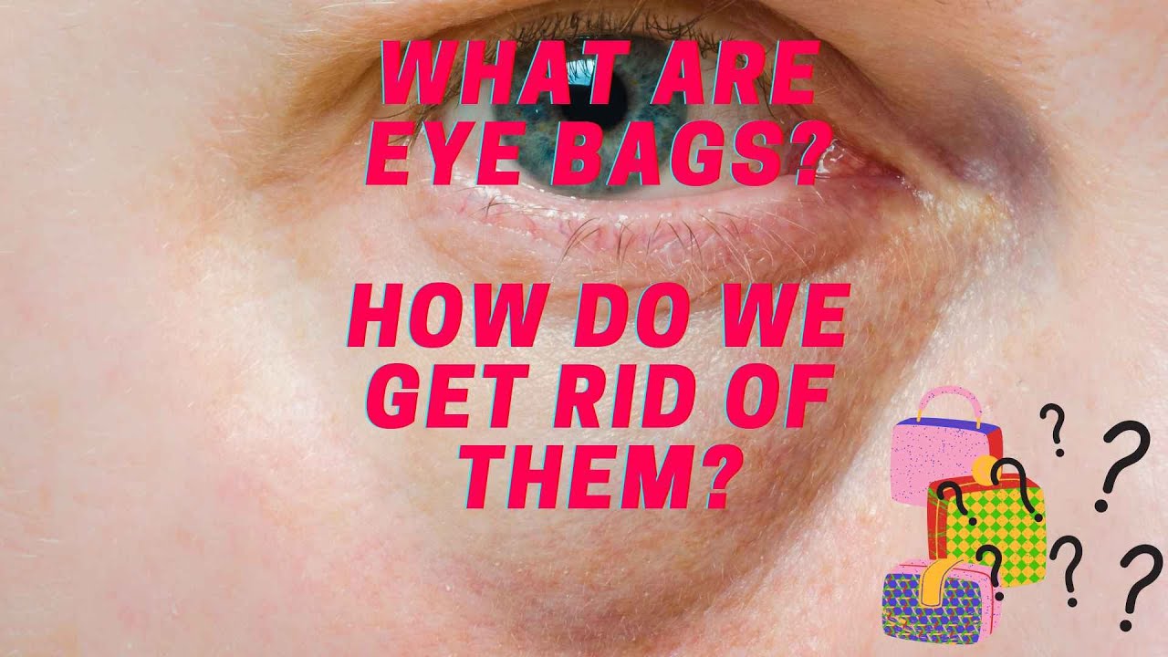 Faq what are eye bags and how do we get rid of them dr anthony