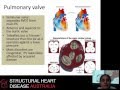 Pulmonary valve pathology and echocardiographic assessment - Dr Liza Thomas