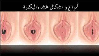 انواع غشاء البكارة | ترقيع غشاء البكارة | غشاء البكارة الصينية