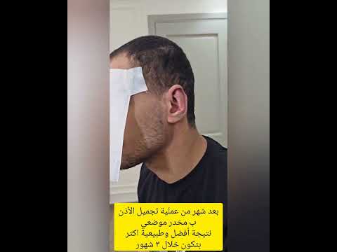 نتيجة بعد شهر من تجميل الأذن البارزة مخدر موضعي   