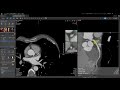 Vitrea Applications Demonstrations | CT Cardiac Analysis