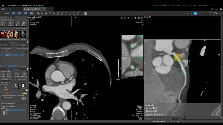 Vitrea Applications Demonstrations | CT Cardiac Analysis