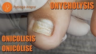 Onycholysis due to trauma #podology #asmr