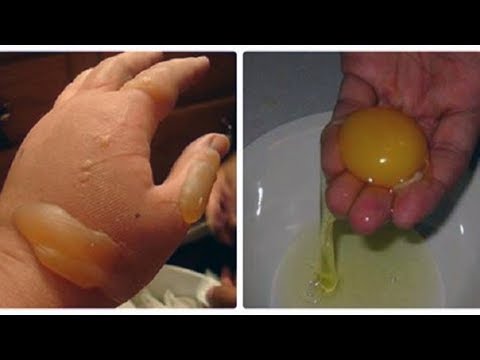 Video Bị Bỏng Nặng Cỡ Nào Chỉ Cần 1 Quả Trứng Gà, Sau 10... - youtube