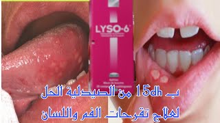 ب 15dh من الصيدلية الحل لعلاج تقرحات الفم و اللسان Lyso-6