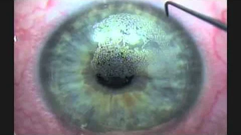 Bladeless, All Laser Lasik- " In Simple English"