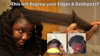 Use This Twice a Week and Your Hair Will Never Stop Growing| DIY for EDGES REGROWTH & BALDING‼