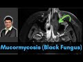 Mucormycosis (ROCM) : Imaging and Pitfalls | Dr. Venkatesh Manchikanti | @Shades of Radiology