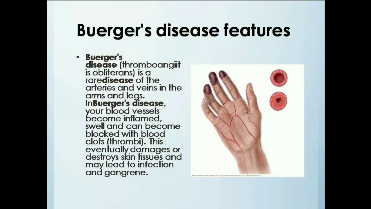 How to study Buerger s disease YouTube