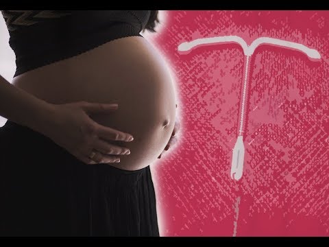 Vídeo: Embarazada Con DIU: Síntomas, Complicaciones, Terminación Y Más