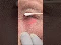 Skin Tightening Laser Resurfacing Shorts Skin Tightening Laser Resurfacing Shorts