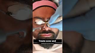 Carbonpeel For Glowing Skin by Dr Lalit Kasana's