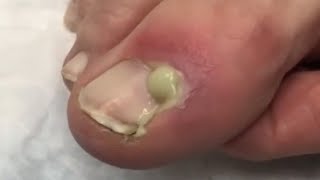 Dr Gilmore Nail Treatment, Paronychia?