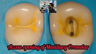 Access opening of Maxillary Premolar# step by step root canal demonstration#rct for beginners