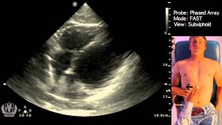 FAST Scan (Focused Assessment with Sonography in Trauma) - STEP by STEP