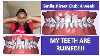 Smile Direct Club 4 week review | ARE MY TEETH RUINED!?!?!?