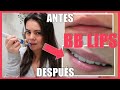 💋 BB LIPS en Casa 💋 TUTORIAL con DERMAPEN con Ácido HIALURÓNICO Dr Pen Nano Agujas Microneedling