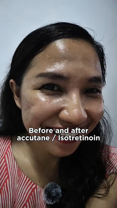 The Real Accutane Result: My Before and after transformation