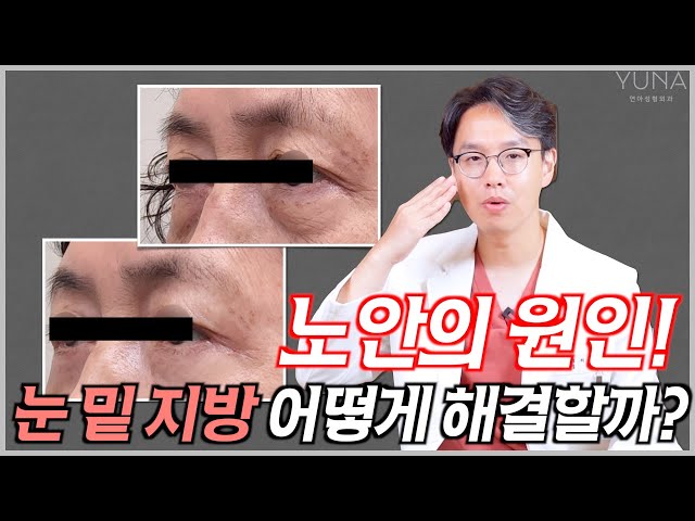 노안의 주범.. 눈 밑 지방제거 나한테 맞는 수술 방법은!?