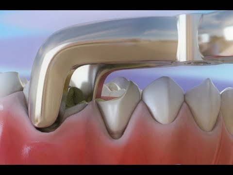 वीडियो: दांत निकालना कैसे काम करता है?