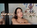 why having acne DOESN'T make you ugly, let's talk + q&a [self-love series]