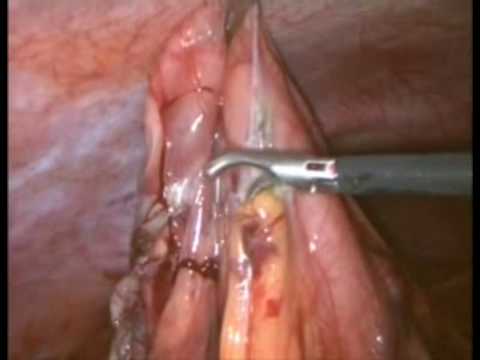 ถุงน้ำในตับ laparoscopic treatment of large hepatic cyst