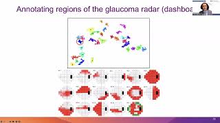 Artificial Intelligence (AI) models for making glaucoma assessment more objective (8 Aug 2023)