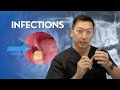 Infections after Wisdom Teeth Removal