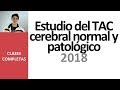 Estudio del TAC cerebral normal y patológico - Videoclase completa 2018