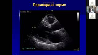Эхокардиография в диагностике заболеваний перикарда