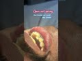 😱😍 Shocking open coil spring in braces treatment #braces #hyderabaddentist #orthodontics #trend