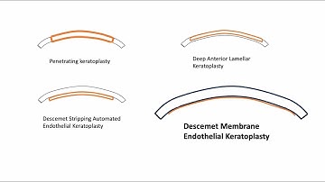 Corneal Transplant : PKP, DALK, DSEK, and DMEK