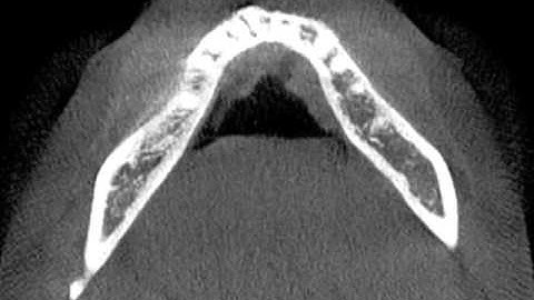 Fusion as seen on Cone Beam CT